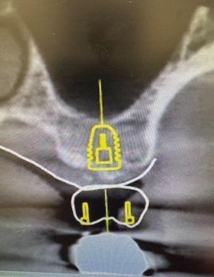 3D Guided Implant Placement, minimally invasive. Protecting anatomical landmarks including the sinus with precise perfect placement.