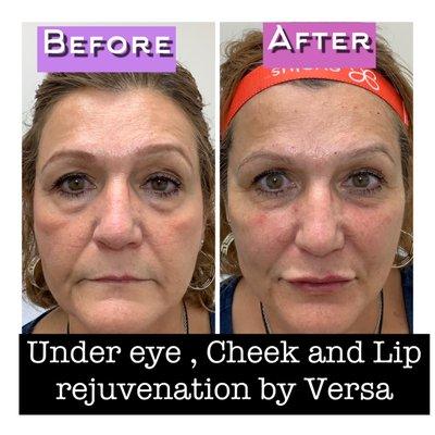 Under eye, cheek and lip rejuvenation by Versa