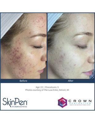 Microneedling for Acne scars and pigmentation