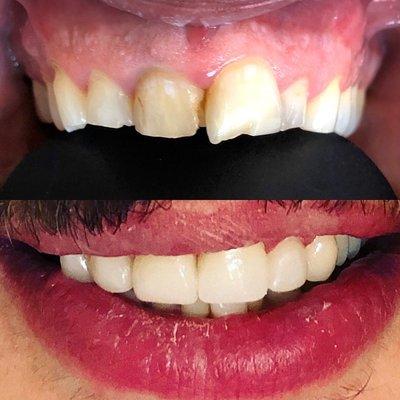 Before and after of incredible smile transformation with 3D technology.