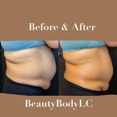 Client booked a lipo cavitation and laser pads session giving her a mixture or both machines to achieve her weight loss goals