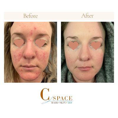 Before and After photos of B -- At-home  guidance with Paige from C Space and a mix of For You Skin Rituals and Hale & Hush products.