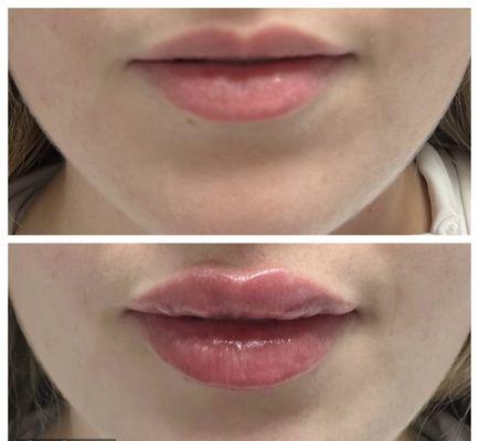 Beautiful before & after lip filler. At Vitology we focus on enhancing your natural beauty!