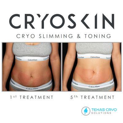 Cryotherapy Celina TX