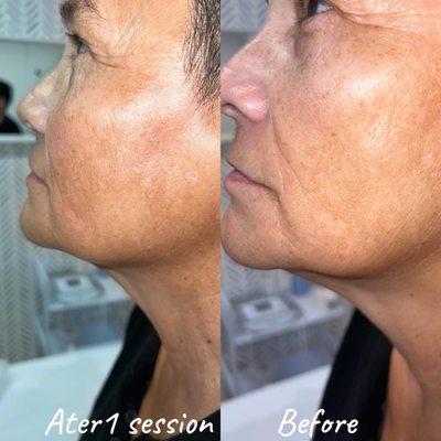 Anti Wrinkle Skin Treatment