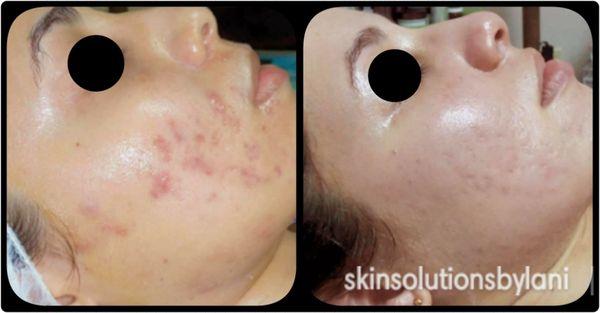 Acne/Scar Treatment