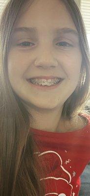 New set of Braces