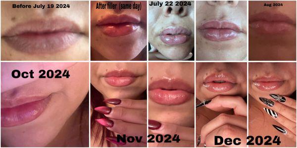 Lip filler: July 2024-Dec 2024