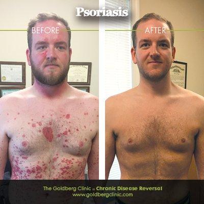 Psoriasis Before and After