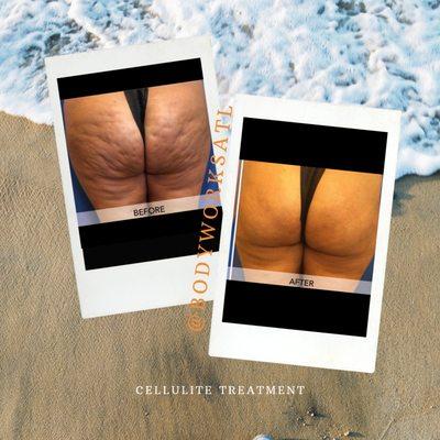 Cellulite Therapy