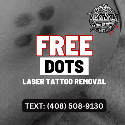 We offer FREE dots tattoo removal for former gang members or radiation markers