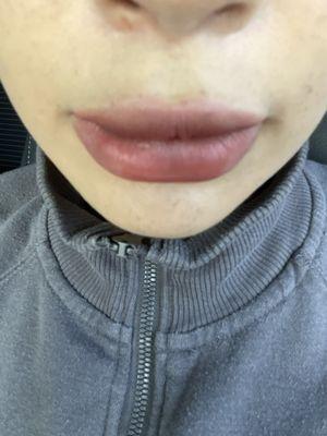 Uneven ducky lips