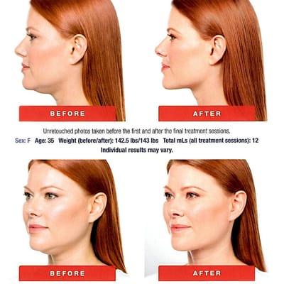 Now offering Kybella - a non-surgical treatment to reduce the "double chin"!