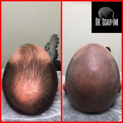 3 session 3/4 coverage male pattern baldness