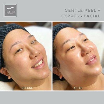 In 45 minutes ... Gentle Peel + Express Facial = Clear Pores 'n Bright, Glowy Complexion