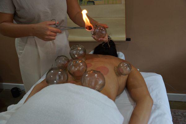 Cupping for back pain