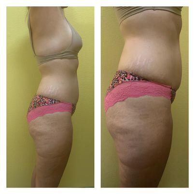 Before and after first session of body cavitation! Helps reduce cellulite, stretch marks, slimming the waist and thighs.