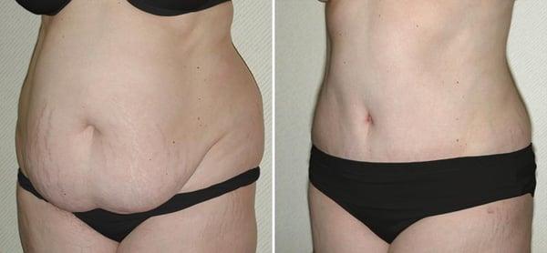 Abdominoplasty or "tummy tuck" is a cosmetic surgery procedure used to make the abdomen thinner and more firm...