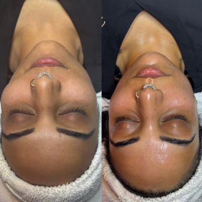 Deluxe HydraFacial before and after