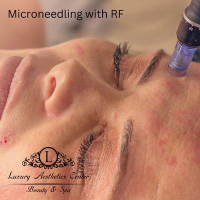 Microneedling with RF, create for acne, elasticity, scars and much more.