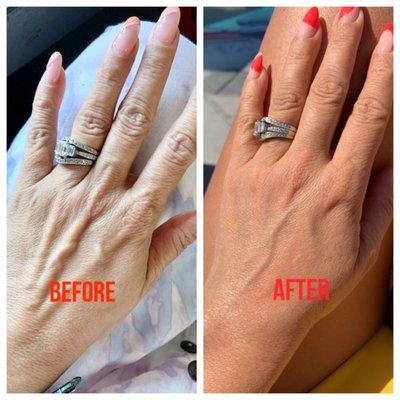 Plasma Lift Hand Treatment