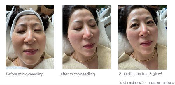 Micro-needling Deluxe treatment for graceful aging, tightening and glow!  Treatment includes whole body acupuncture too!