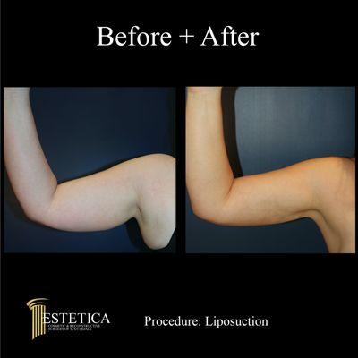 Liposuction of the arm!  A great, less invasive way of tightening that skin & getting rid of that pesky extra fat.