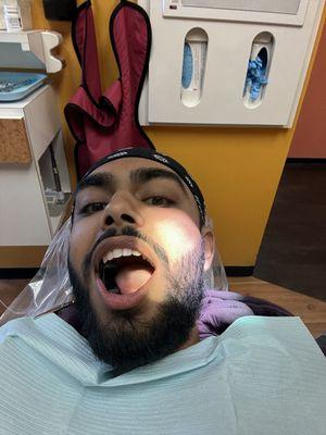 Fillings done.  Very comfortable and not painful at all. Dr. Brar did a great job