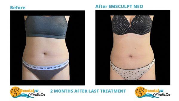 Emsculpt Neo results