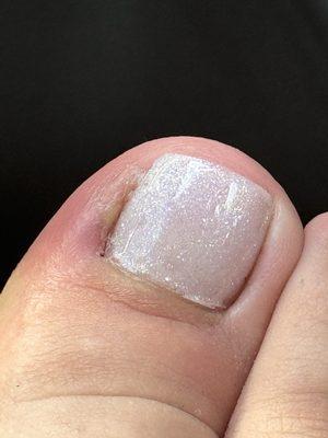 Infected toe