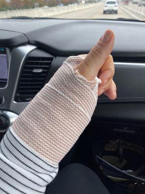 Second surgery cast