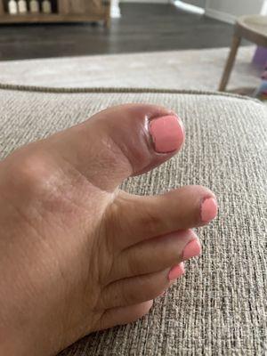 Horribly infected toe after a pedicure here-- don't go here.