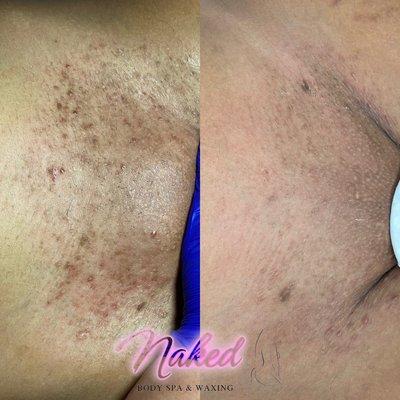 Before & After results. Dark marks & Hyperpigmentation treated!