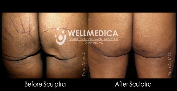 Scluptra butt lift before and after