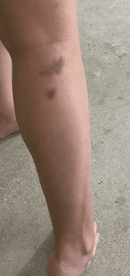 Bruises from Deputy Steven Davis - excessive force