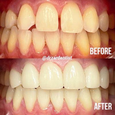 Here is a smile transformation using veneers! We'd love to help you have a more healthy and confident smile!