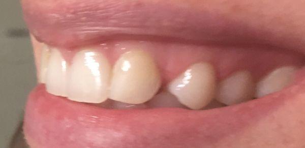 Left side before veneers