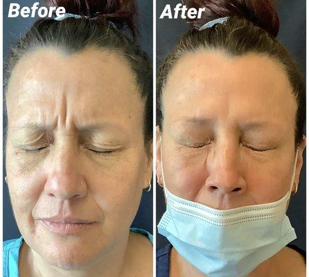 Results from Xeomin injections!