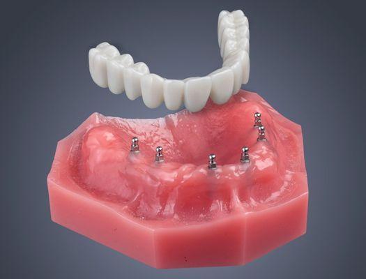 Full row teeth restoration using denture implants for $3000 only plus the denture from $499 only