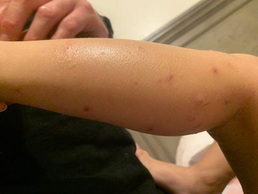 Bug bites from sandbox.. maybe fire ants? Or mosquitoes? :(