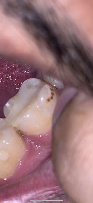 Stained/burned my teeth when polishing