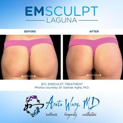 Emsculpt Glutes - booty lift