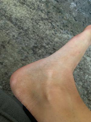 Ankle