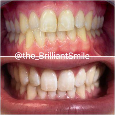 Invisalign and Whitening