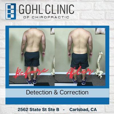 Case is before and after- 7 minutes after a Gonstead Adjustment