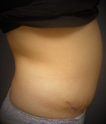 Patient presented after 3 months of her Tummy tuck and Smart-Lipo combination, Patient seems happy with her results.