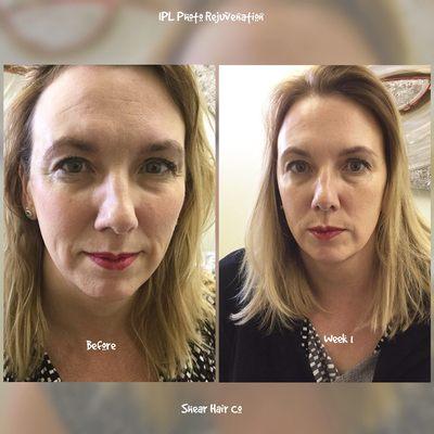 IPL Photo rejuvenation