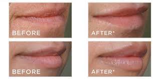 Lip Augmentation with Juvederm