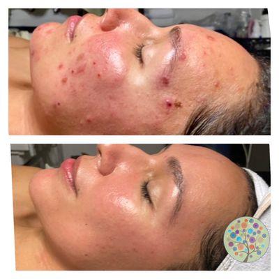 Acne facials every 3 weeks, Vivant Propeel and Vivant home care regimen.