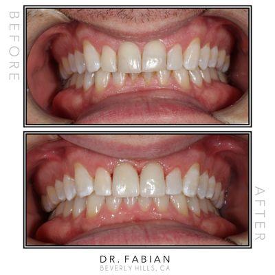 Can't tell which one is before or after? That's the point. Patient had large composite fillings on his front teeth that kept on breaking.